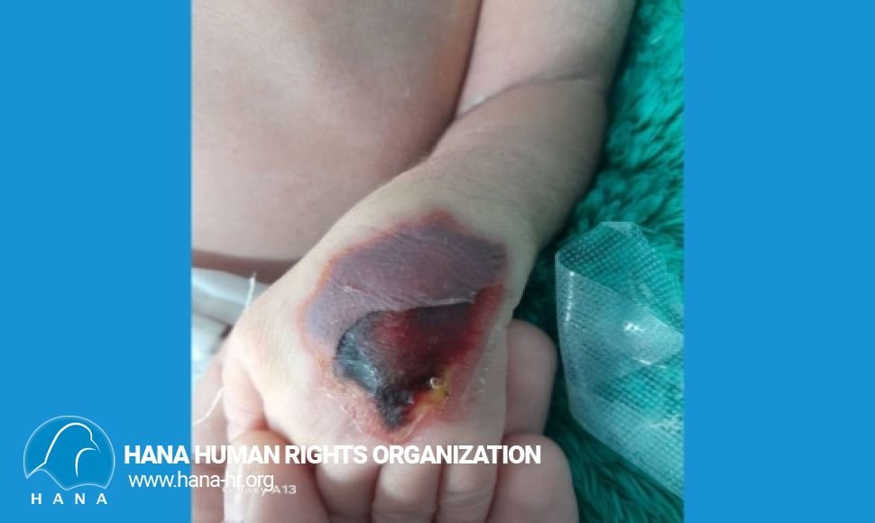 هەڵەیەکی گەورەی پزیشکی و مەترسی خستنە سەر ژیانی منداڵێکی یەک ڕۆژە لە نەخۆشخانەی ئێرانی شاری ئێرانشار